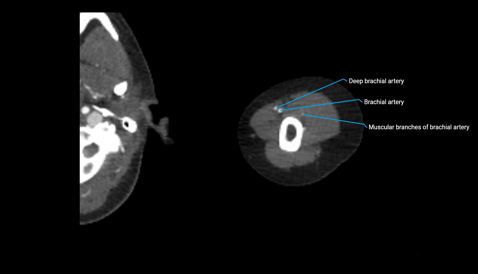 CTA upper limb axial cross sectional anatomy labelled image 270 (2).webp